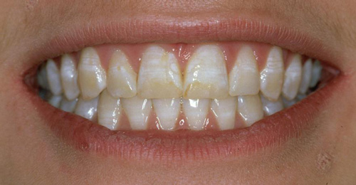 blegning af tænder før