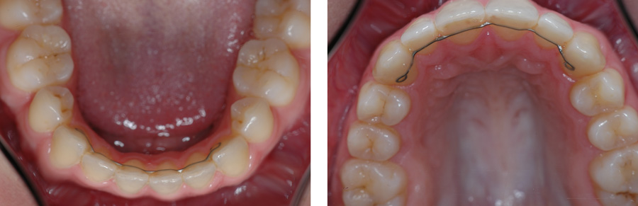 Ståltrådssikring behandling af skæve tænder