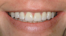 hvide tænder